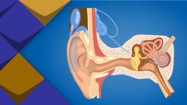 Cochlea Implantat - Hörprothese